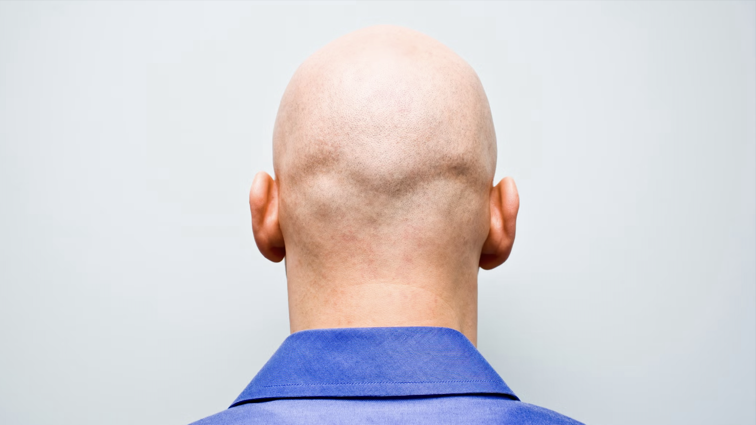 los-3-mitos-sobre-la-calvicie-que-la-ciencia-ya-desmintio-y-aun-creemos